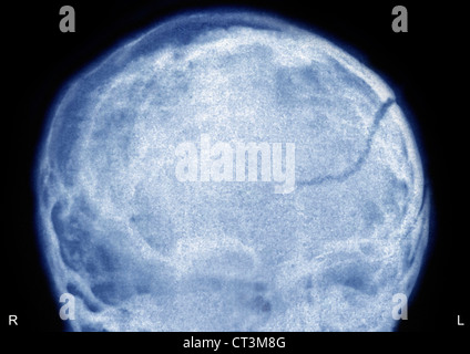 Fracture du crâne, X-RAY Banque D'Images