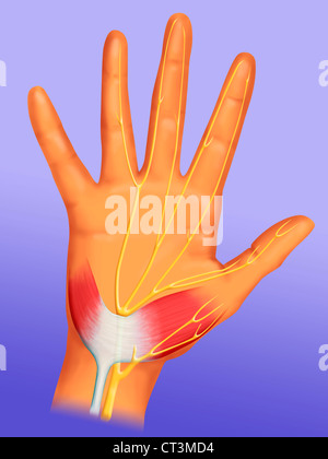 Le syndrome du tunnel carpien, dessin Banque D'Images