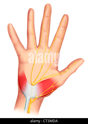 Le syndrome du tunnel carpien, dessin Banque D'Images