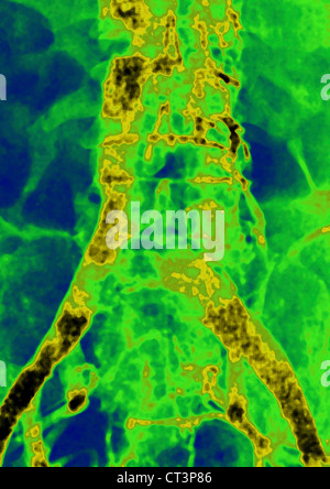 La thrombose iliaque, angiographie Banque D'Images