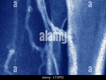 Veine THOMBOSED, angiographie Banque D'Images