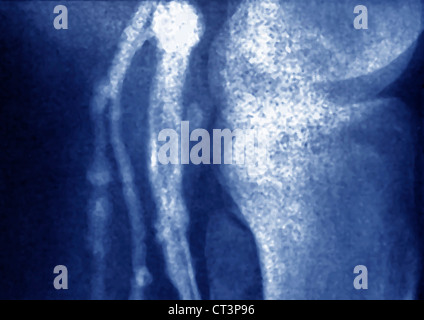 Veine THOMBOSED, angiographie Banque D'Images