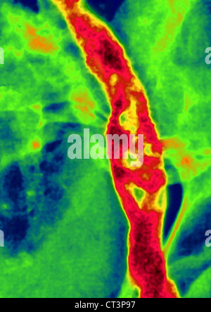 La thrombose iliaque, angiographie Banque D'Images