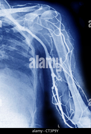 Membre supérieur, angiographie Banque D'Images