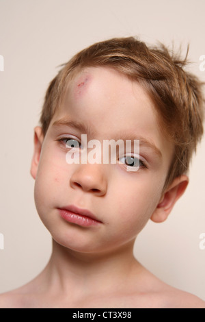 Enfant avec l'hématome Banque D'Images