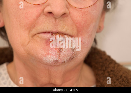 L’HERPÈS ZOSTER Banque D'Images