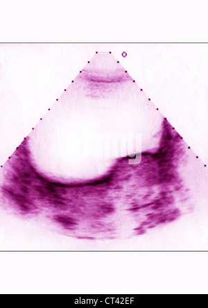 Fibrome utérin, l'échographie Banque D'Images