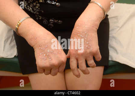 Dermatologie, TRAITER LES PERSONNES ÂGÉES P. Banque D'Images