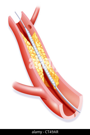 L'angioplastie artérielle, ILLUST. Banque D'Images