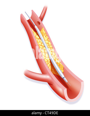 L'angioplastie artérielle, ILLUST. Banque D'Images