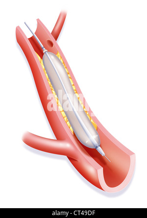 L'angioplastie artérielle, ILLUST. Banque D'Images