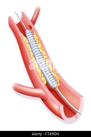 L'angioplastie artérielle, ILLUST. Banque D'Images