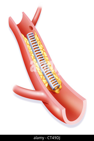 L'angioplastie artérielle, ILLUST. Banque D'Images