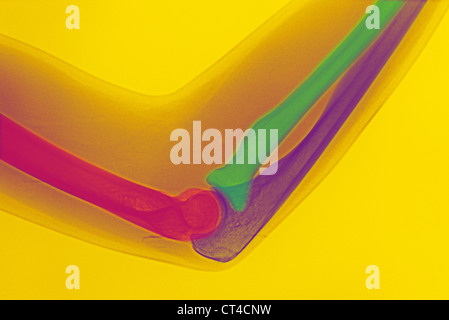 COUDE, RAYONS X Banque D'Images