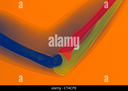 COUDE, RAYONS X Banque D'Images