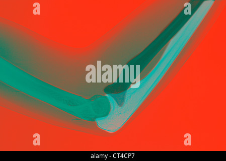 COUDE, RAYONS X Banque D'Images