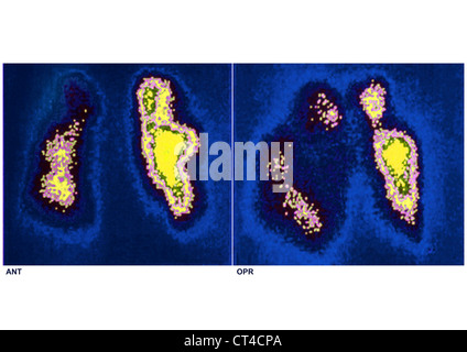 L'embolie pulmonaire, SCINTISCAN Banque D'Images