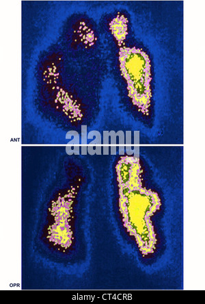 L'embolie pulmonaire, SCINTISCAN Banque D'Images