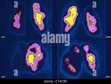 L'embolie pulmonaire, SCINTISCAN Banque D'Images