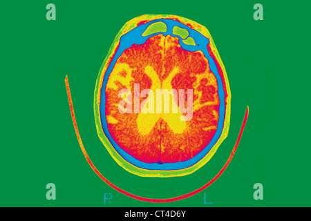 La maladie d'Alzheimer, de numérisation Banque D'Images