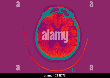 La maladie d'Alzheimer, de numérisation Banque D'Images