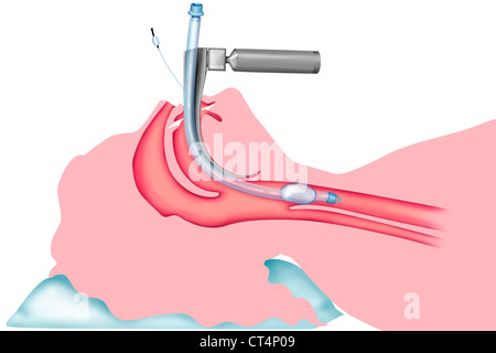 L'intubation trachéale Banque D'Images