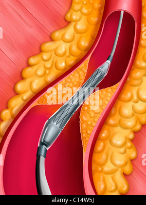 L'angioplastie artérielle, ILLUST. Banque D'Images