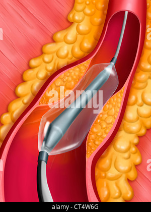 L'angioplastie artérielle, ILLUST. Banque D'Images