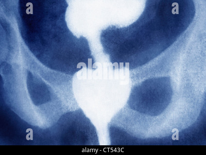 Le carcinome rectal, X-RAY Banque D'Images