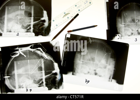 L'électrostimulation du cerveau, X-RAY Banque D'Images