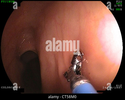 L'ablation des polypes du côlon, l'ENDOSCOPIE Banque D'Images