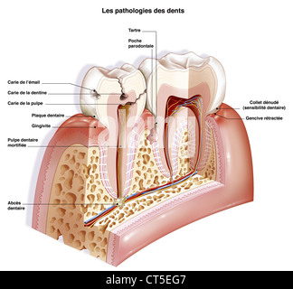 La pathologie DENTAIRE, dessin Banque D'Images