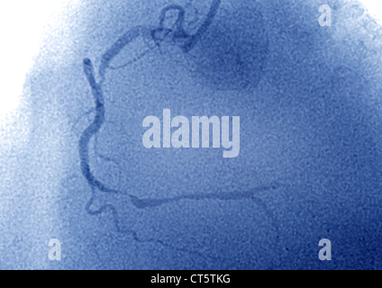 Infarctus du myocarde, ANGIOGRA. Banque D'Images