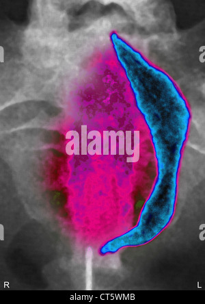 Fibrome utérin, X-RAY Banque D'Images