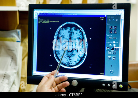 L'électrostimulation du cerveau, RMN Banque D'Images