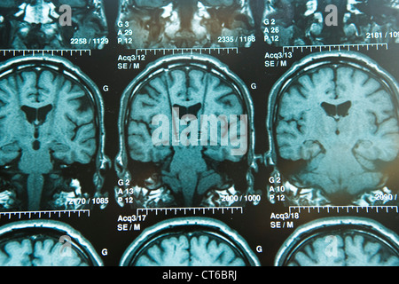 L'électrostimulation du cerveau, RMN Banque D'Images