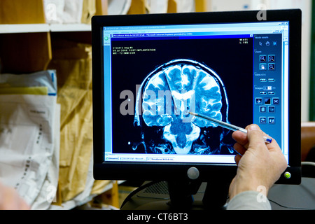 L'électrostimulation du cerveau, RMN Banque D'Images