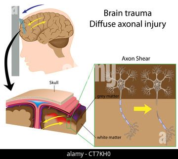 Traumatismes du cerveau de cisaillement avec axon Banque D'Images