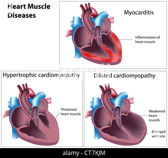 Les maladies du muscle cardiaque Banque D'Images