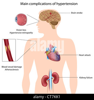 Les complications de l'hypertension Banque D'Images