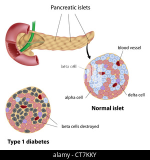 Îlot pancréatique normal et diabétique de type 1 Banque D'Images