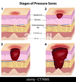 Étapes d'escarres Banque D'Images