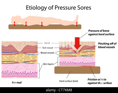 Étiologie des escarres Banque D'Images