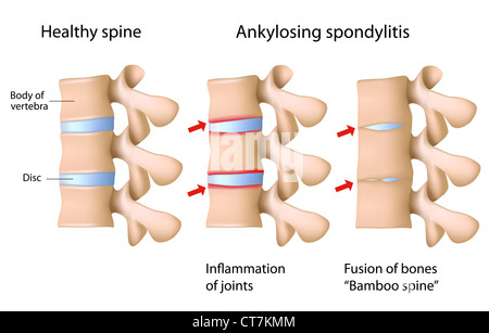 La spondylarthrite ankylosante de l'épine Banque D'Images