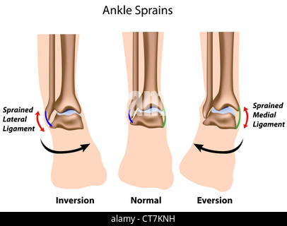 Types d'entorses de cheville Banque D'Images