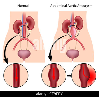 L'anévrisme de l'aorte Banque D'Images
