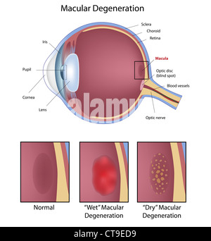 Condition oculaire : dégénérescence maculaire Banque D'Images