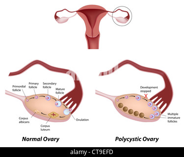 Ovaire normal et un syndrome des ovaires polykystiques Banque D'Images