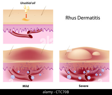 La dermatite de contact induite par l'huile Urushiol Banque D'Images