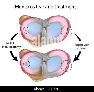 Déchirure du ménisque et chirurgie Banque D'Images